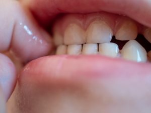 What are the effects of bruxism