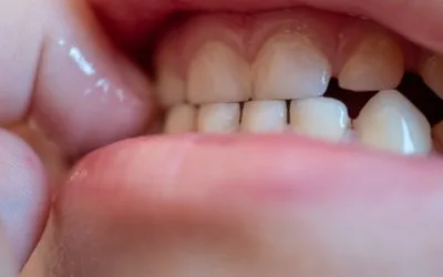 Teeth Grinding in Children: What are the Effects of Bruxism?